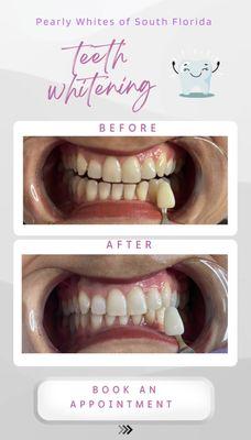 Professional teeth whitening, same days results. Pain free