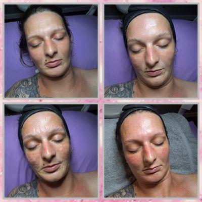 Skin tightening facial