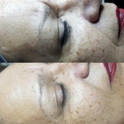 Dermaplaning, before and after.