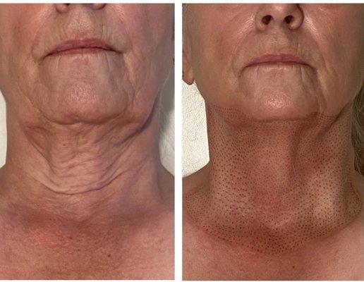 Neck lift