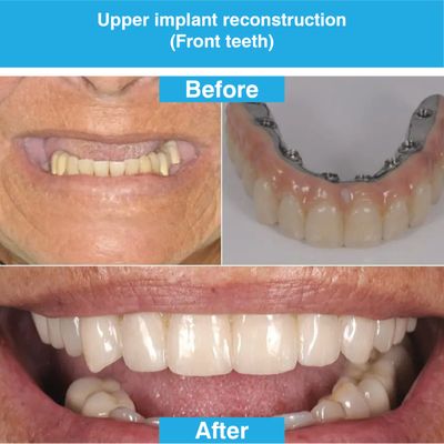 Upper implant reconstruction