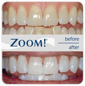 Call today for our current ZOOM Whitening Special