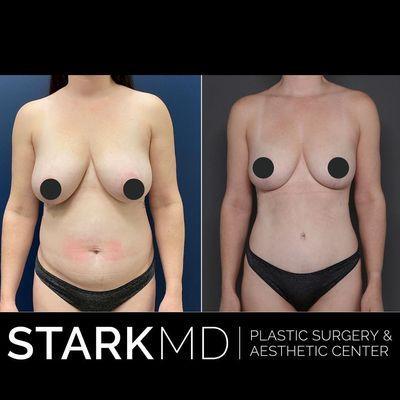 Breast Reduction Philadelphia