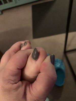 The bleeding cut caused by an inexperienced nail tech