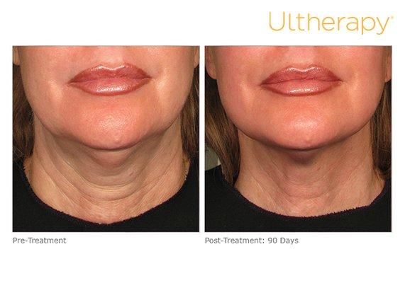 Ultherapy: Lower face & Neck (Before & After)