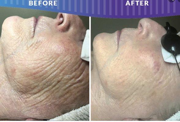 Microneedling