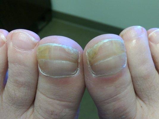 FDA cleared toenail Fungus Laser Therapy.