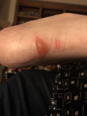 This is a photo of the blister on my heel from my previous post about the ankle brace.