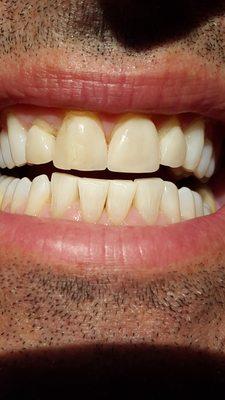 My old cracked receded veneers before Dr. Horvath's majic.