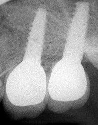 X-Ray of upper jaw implants with crowns.  Implants placed by Dr. Yuly Gertsberg