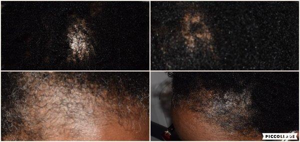 The photos on the left are of my scalp and crown 3 months before I began treatment.  The photos on the right are after.