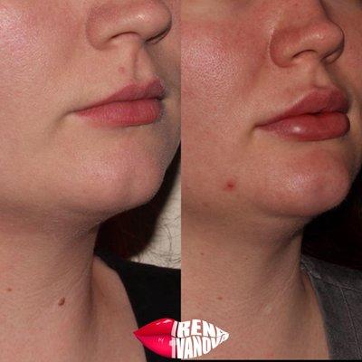 Before and after done by nurse injector, Irena. Restylane Defyne filler was used for this lip augmentation.