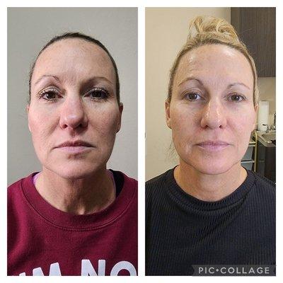 RF Skin Tightening treatments