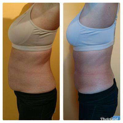 The amazing results of Laser Lipo by Gina