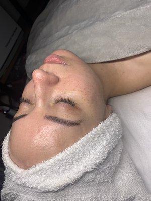 Post bt micro facial with lightening lift micro peel