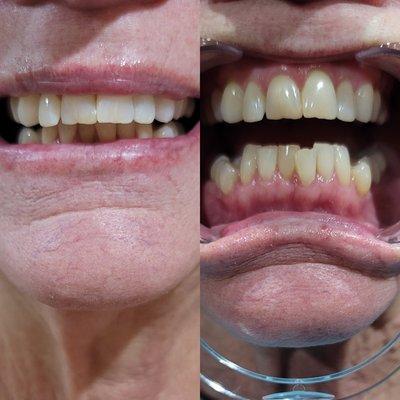 Here is a before and after for teeth whitening. I do offer this service.