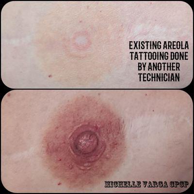 Postmastectomy Areola Artistry