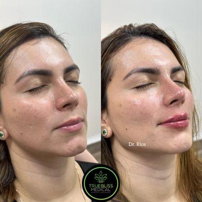 Chin and Jaw Peofile with Dermal Fillers