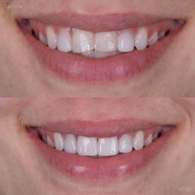 This patient was tired of replacing her bondings on her 2 front teeth so Dr. Rodriguez made her 2 aesthetic ultra thin veneers.