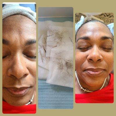 Dermaplaning Client