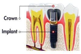 Dental Implant in Fremont, CA