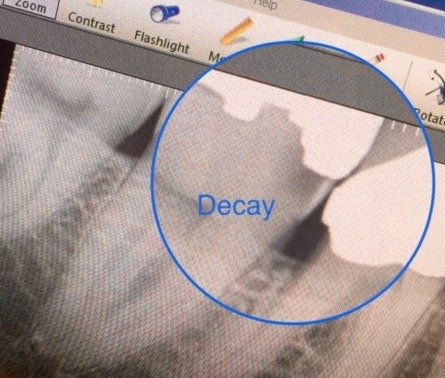 Digital x-rays help diagnose decay below older amalgam filling