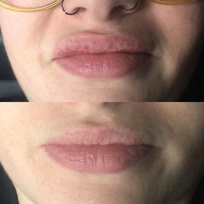 Full pout lip augmentation