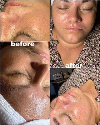 Before and after of a dermaplane facial