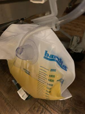 urine bag almost full due to neglect.