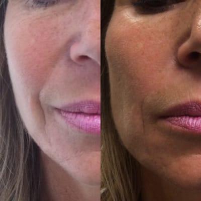 One syringe of FDA approved Voluma helped to beautifully sculpt our client's cheeks and reduce the fine lines around her mouth!