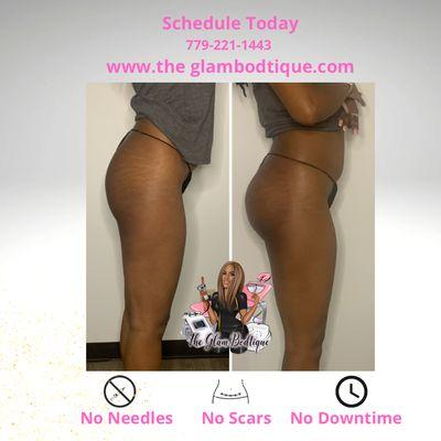 Butt enhancement treatment