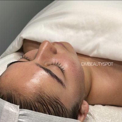 Post dermaplane facial