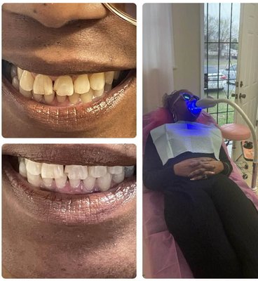 Teeth whitening & Gems