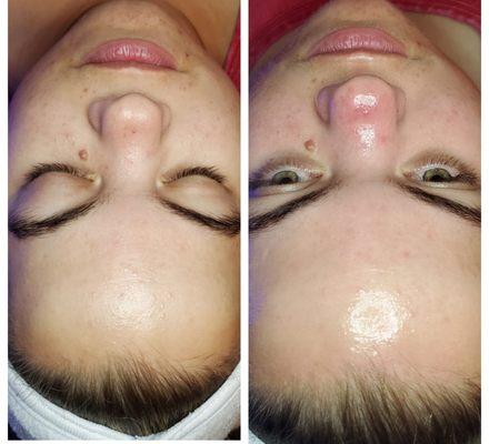 Signature Hydrafacial