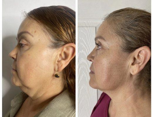 Fibroblast Treatment helps tighten up loose skin & helps produce new collagen This procedure can  last up to 3years .