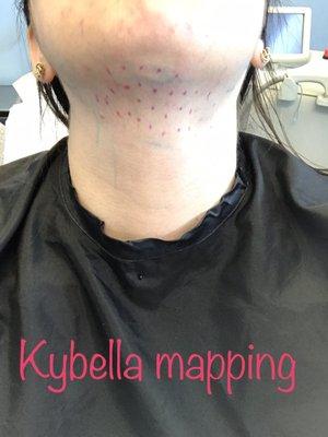 Got my Kybella done at Oomph!