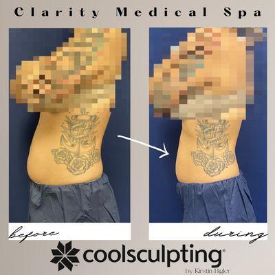 Coolsculpting done by Kirstin Bigler