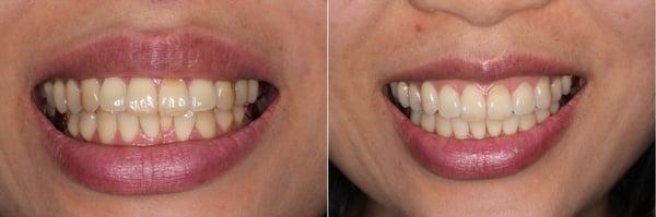 Before and After of Invisalign