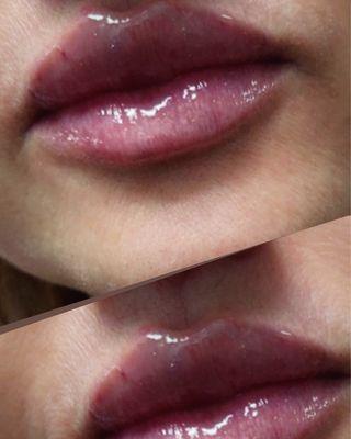 Lip enhancement