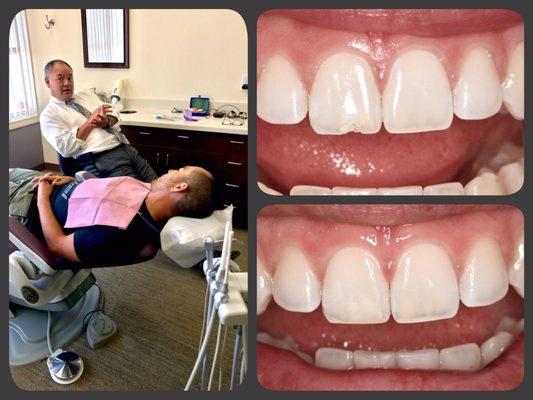 Cleaning, Exam and Repair chipped tooth