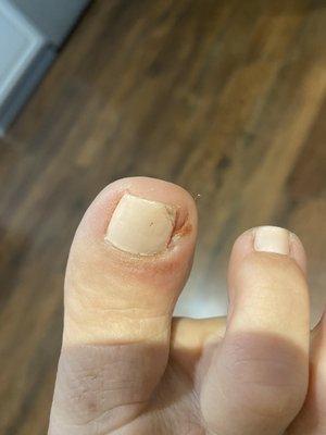 Infected toe