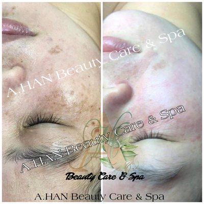 Dark spot Treatment