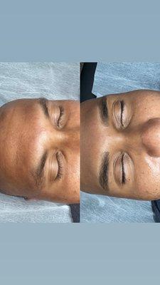 Microblading