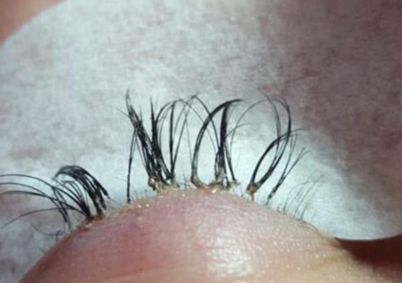 Infection after getting eye lashes done at this horrible business