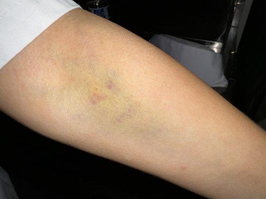 Bruising from IV