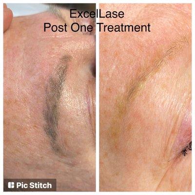 Laser tattoo removal on eyebrow micro blading post one treatment at Excellase Raleigh