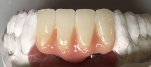 Implant retained anterior porcelain to zirconium bridge with customized pink porcelain to mimic the missing gingival architecture.