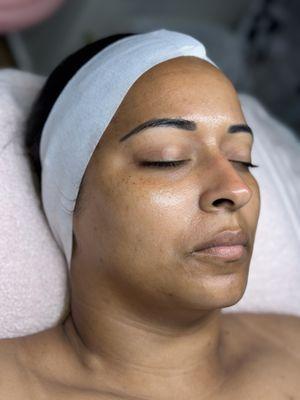 Hydrafacial + Dermaplane post glow