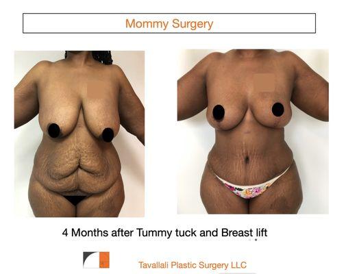 4 months tummy tuck Breast lift