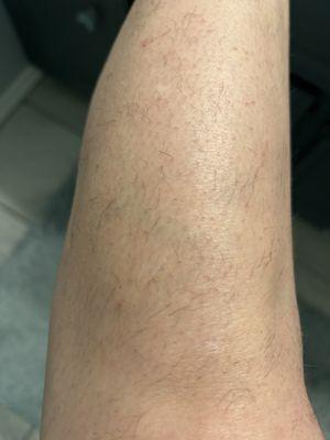 My leg had the best results and as you can see it's definitely not great!